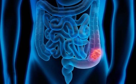 Kolon Kanseri Belirti Vermeden İlerleyebilir, Erken Teşhisle Sağlığınızı Koruyun