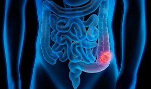 kolon-kanseri-belirti-vermeden-ilerleyebilir-erken-teshisle-sagliginizi-koruyun.jpg